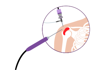 Orthopaedics & Joint Replacement
