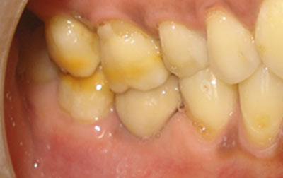 venkateshwarhospitals after  teeth treatment
