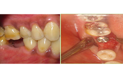 venkateshwarhospitals after  teeth