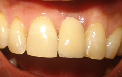 venkateshwarhospitals dwarka  after  teeth treatment