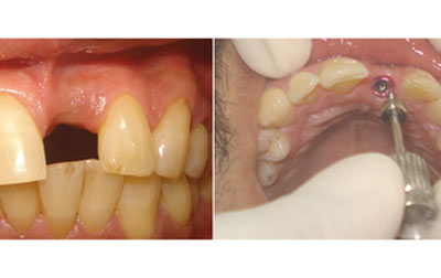 venkateshwarhospitals dwarka  before  teeth treatment