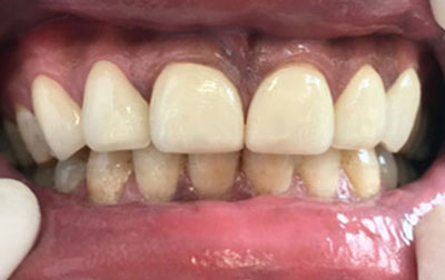 case-teeth treatment