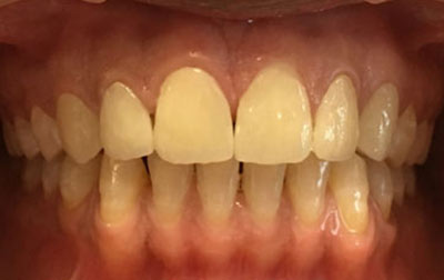 venkateshwarhospitals Case teeth  treatment 