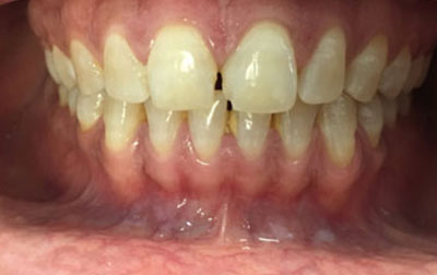 venkateshwarhospitals teeth treatment