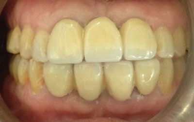 Teeth Case Treatment venkateshwarhospitals