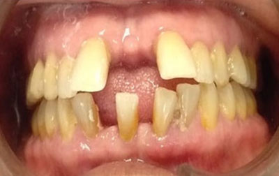 Teeth Case Treatment