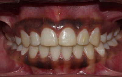 venkateshwarhospitals teeth case treatment