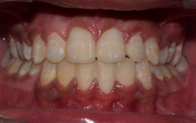 venkateshwarhospitals after case teeth
