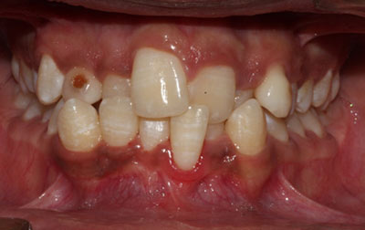 venkateshwarhospitals before case teeth