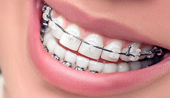 Metal braces